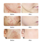 Acne Face Cream with Lactic Acid — product photo 6 of 9