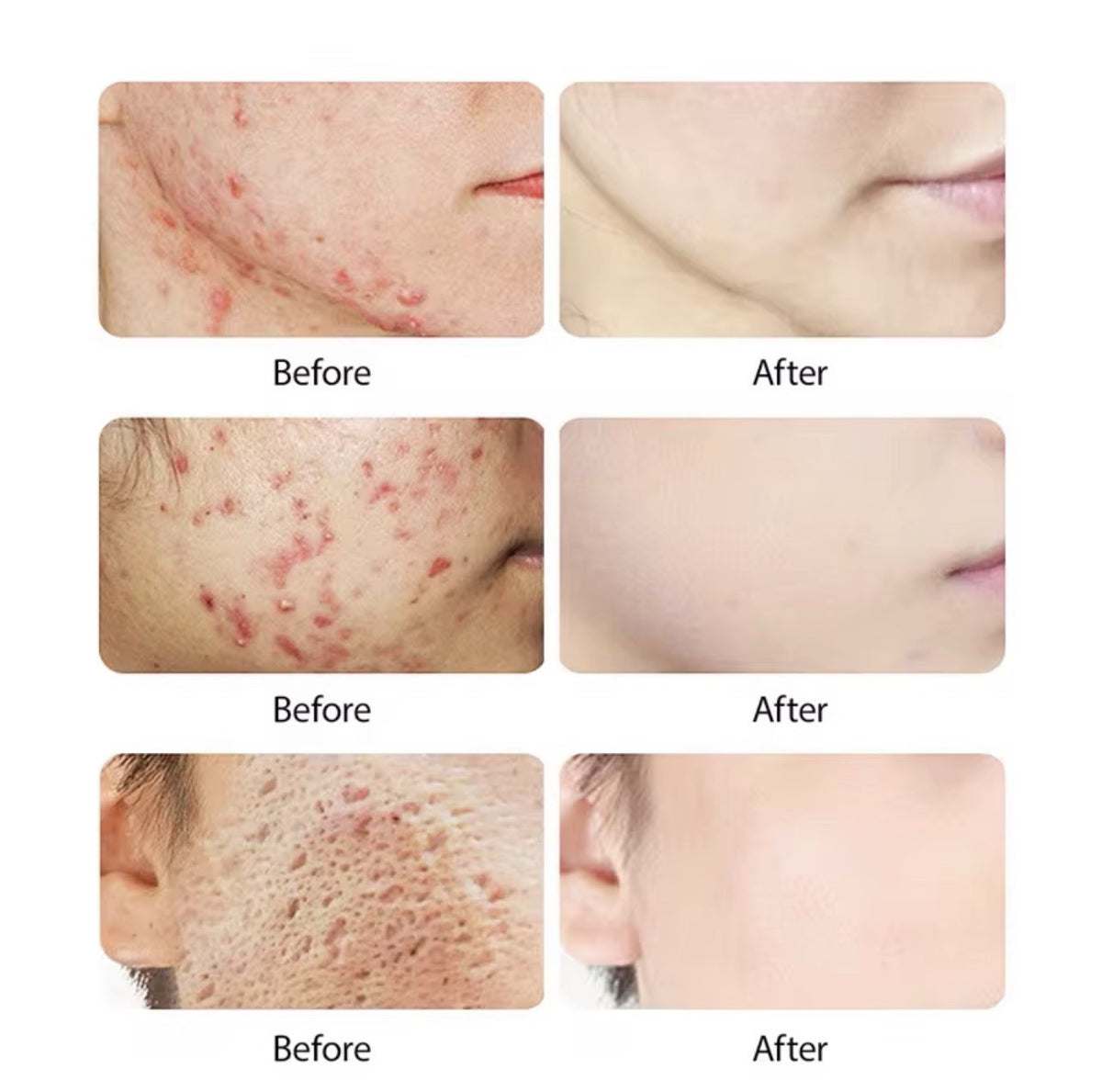 Acne Face Cream with Lactic Acid — product photo 6 of 9