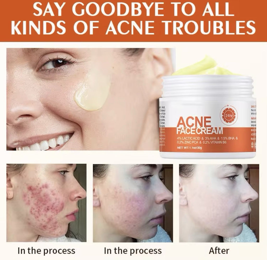 Acne Face Cream with Lactic Acid — product photo 7 of 9
