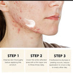 Acne Face Cream with Lactic Acid — product photo 8 of 9