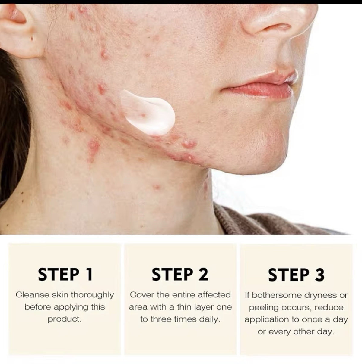 Acne Face Cream with Lactic Acid — product photo 8 of 9
